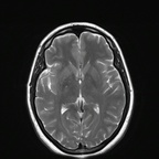 Orbitopathie basedowienne avec exophtalmie droite de grade I T2 TSE TRA Orbitopathie basedowienne avec exophtalmie droite de grade I T2 TSE TRA