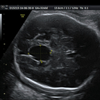 Syndrome polymalformatif avec atteinte des structures de la ligne médiane : diagnostic prénatal et imagerie postnatale img008 Syndrome polymalformatif avec atteinte des structures de la ligne médiane : diagnostic prénatal et imagerie postnatale img008