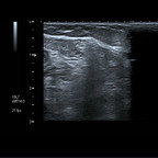 Neurofibrome nerf ulnaire Echographie du coude Axial Neurofibrome nerf ulnaire Echographie du coude Axial