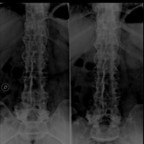 Spondylarthrite ankylosante Rdaiographies standard Spondylarthrite ankylosante Rdaiographies standard