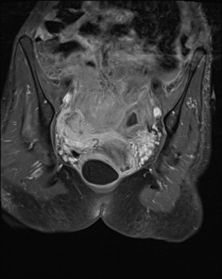 Rectal obstruction due to endometriosis Coronal T1 Gado FatSat