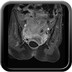 Rectal obstruction due to endometriosis Portal-phase axial CT
