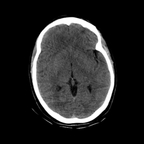 traumatisme vasculaire abdominal, rupture de vessie intra péritonéale, ischémie de rate, fracture pelvienne crane axial mou traumatisme vasculaire abdominal, rupture de vessie intra péritonéale, ischémie de rate, fracture pelvienne crane axial mou