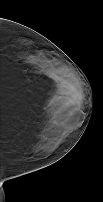 Doubt regarding architectural distortion of the right upper lateral quadrant, corresponding to superimpositions with tomosynthesis. LCC Tomosynthèse