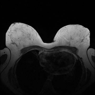 Récidive tardive de cancer du sein gauche T1