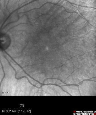 Cataracte sous capsulaire postérieure et astigmatisme cornéen - Implantation multifocale torique Clichés IR ODG