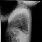 Médiastinite et fistule oesophago-trachéale caustique Rx Thorax Médiastinite et fistule oesophago-trachéale caustique Rx Thorax