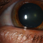 Cataracte sous capsulaire postérieure et astigmatisme cornéen - Implantation multifocale torique Photos LAF ODG Cataracte sous capsulaire postérieure et astigmatisme cornéen - Implantation multifocale torique Photos LAF ODG