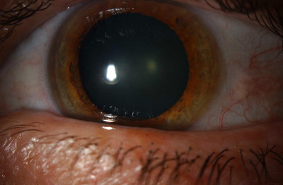Cataracte sous capsulaire postérieure et astigmatisme cornéen - Implantation multifocale torique Photos LAF ODG