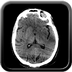 Clinical case 14 - Polytrauma due to high-speed road traffic accident, light vehicle against light vehicle, patient driving and wearing belt