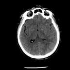 traumatisme cranien, dissection carotidienne, perforation digestive, traumatisme artère pulmonaire, fracture de Chance crane axial mou traumatisme cranien, dissection carotidienne, perforation digestive, traumatisme artère pulmonaire, fracture de Chance crane axial mou