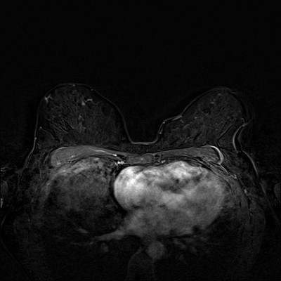 Right upper medial ductal carcinoma in situ Soustraction 1 min