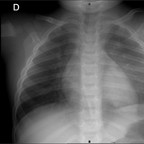 Foyers de pneumopathie chez l'enfant : localisations difficiles Chad Rx face Foyers de pneumopathie chez l'enfant : localisations difficiles Chad Rx face
