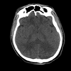 traumatisme thoracique, hématome sous capsulaire hépatique, traumatisme du bassin. crane axial traumatisme thoracique, hématome sous capsulaire hépatique, traumatisme du bassin. crane axial