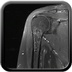 Incidental finding of a left proximal humerus lesion Coronal T2 Fat Sat MRI