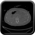 Clinical case 11 - Polytrauma due to a very high-speed single light vehicle road traffic accident