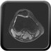 bipartite patella  MRI Lower limb Coronal T1w
