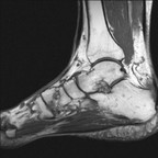 Энтезопатия ахиллова сухожилия с расслоением внутри сухожилия T1 Sagittal Энтезопатия ахиллова сухожилия с расслоением внутри сухожилия T1 Sagittal