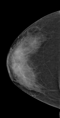 Doubt regarding architectural distortion of the right upper lateral quadrant, corresponding to superimpositions with tomosynthesis. RCC Acquisition Tomo