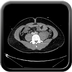 Clinical case 11 - Polytrauma due to a very high-speed single light vehicle road traffic accident