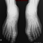 Goutte Radiographie Membre inférieur Goutte Radiographie Membre inférieur