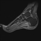 Воспаление подошвенного апоневроза Sagittal DP fat sat Воспаление подошвенного апоневроза Sagittal DP fat sat
