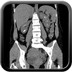 Suivi d'une lithiase.  TDM Abdomen Pelvis  Axial Sans injection
