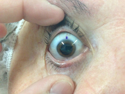 Cataracte sous capsulaire postérieure et astigmatisme cornéen - Implantation multifocale torique Marquage pré opératoire