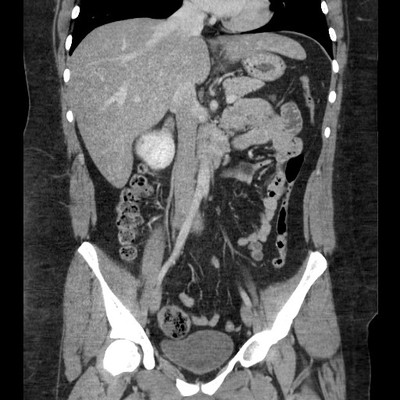 Phéochromocytome bilatéral, tumeurs rénales et kystes rénaux dans le cadre d'une maladie de Von Hippel Lindau TDM portal coronal