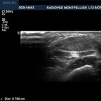 Granulome annulaire profond en avant du tendon rotulien Echographie/Doppler garçon Granulome annulaire profond en avant du tendon rotulien Echographie/Doppler garçon