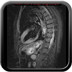 Syndrome de tako-tsubo - Sidération myocardique Ventriculographie