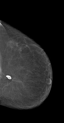 Récidive tardive de cancer du sein gauche LCC Acquisition Tomo