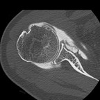 Почти полный отрыв сухожилия подлопаточной мышцы. TDM Membre supérieur Axial Intra-articulaire Почти полный отрыв сухожилия подлопаточной мышцы. TDM Membre supérieur Axial Intra-articulaire