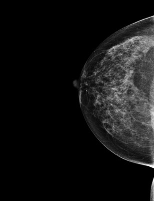 Right upper medial ductal carcinoma in situ RCC