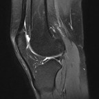 Красный костный мозг IRM Membre inférieur Sagittal STIR Красный костный мозг IRM Membre inférieur Sagittal STIR