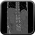 Clinical case 14 - Polytrauma due to high-speed road traffic accident, light vehicle against light vehicle, patient driving and wearing belt