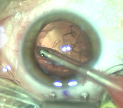 Cataracte sous capsulaire postérieure et astigmatisme cornéen - Implantation multifocale torique Cortex