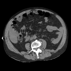 fracture hépatique, saignement actif abdomen sans inj fracture hépatique, saignement actif abdomen sans inj