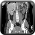 Clinical case 11 - Polytrauma due to a very high-speed single light vehicle road traffic accident