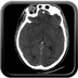 Clinical case 8 - Polytrauma due to a fall of a few meters following a loop while paragliding