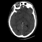 traumatisme cranien, fracture du massif facial, traumatisme thoracique, fracture pelvienne, traumatisme spléno-rénal crane axial mou traumatisme cranien, fracture du massif facial, traumatisme thoracique, fracture pelvienne, traumatisme spléno-rénal crane axial mou