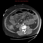 Ischémie mésentérique sur embols de l'artère mésentérique supérieure TDM Abdomen Pelvis Axial Ischémie mésentérique sur embols de l'artère mésentérique supérieure TDM Abdomen Pelvis Axial