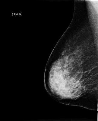 Doubt regarding architectural distortion of the right upper lateral quadrant, corresponding to superimpositions with tomosynthesis. RMLO