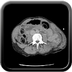Clinical case 14 - Polytrauma due to high-speed road traffic accident, light vehicle against light vehicle, patient driving and wearing belt