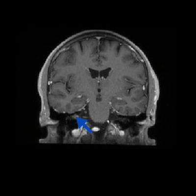 Schwannome cochléovestibulaire (neurinome de l'acoustique) T1 3D GADO AXIAL_MPR_Cor