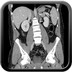 Infarctus sur torsion du grand epiploon  TDM Abdomen Axial Temps veineux