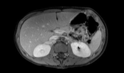 Phéochromocytome et paragangliome dans un contexte de maladie de Von Hippel Lindau ser013img00001