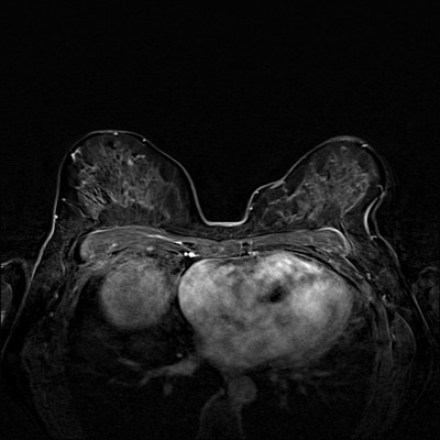 Right upper medial ductal carcinoma in situ Soustraction 4 min