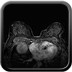 Bilan de microcalcifications ACR 5 RCC
