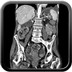 Hernie interne transmésentérique  TDM Abdomen Axial Temps veineux